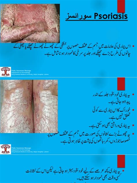 Psoriasis PPT Final Modified | PDF