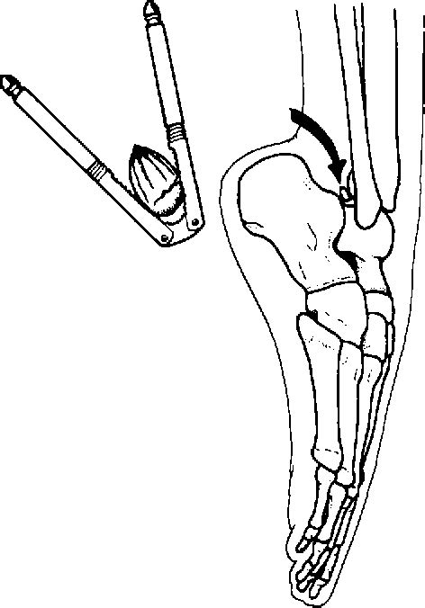 Figure 2 From Posterior Ankle Impingement Semantic Scholar