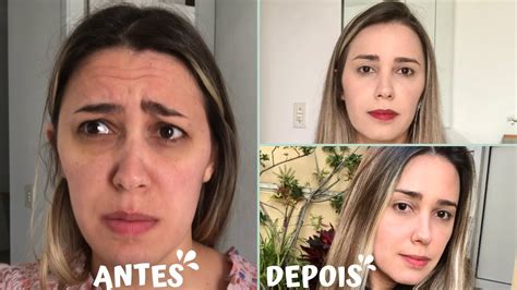 BOTOX FIZ PELA PRIMEIRA VEZ Antes e depois Quanto Custa Dói YouTube