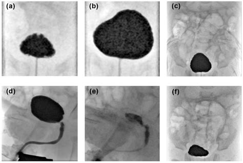 Suprapubic And Transurethral Bladder Access For Voiding