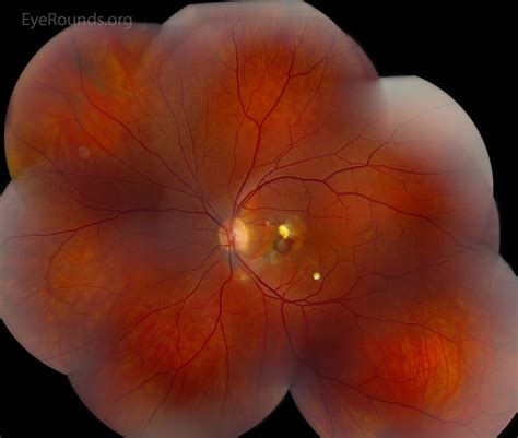 Atlas Entry Choroidal Rupture With Development Of Choroidal Neovascular Membrane Cnvm