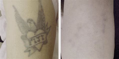 Laser Tattoo Removal Before After Photos Dermmedica Kelowna