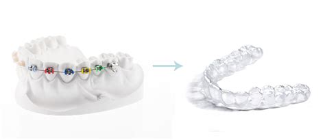 How Long Wear Retainers After Braces Carter Orthodontics