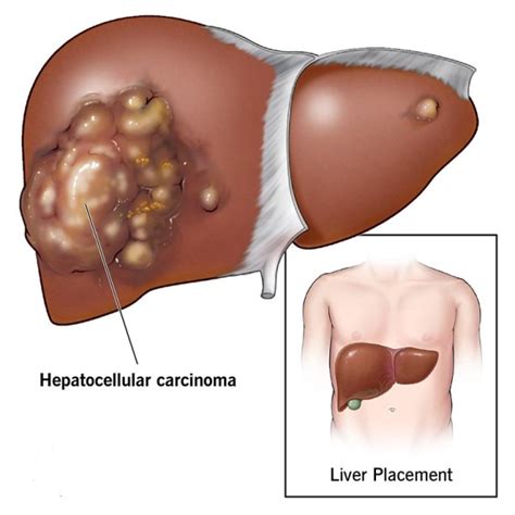 Hepatocellular Carcinoma Cancer Queries