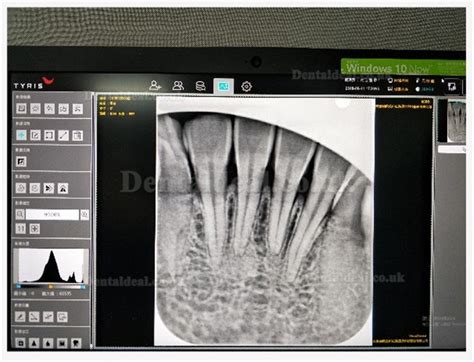 Buy TYRIS TR 100 Dental Intraoral CR Imaging Plate Scanner PSP X Ray