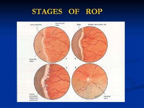 Retinopathy Of Prematurity Dr Ajay I Dudani M