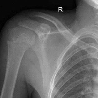 Radiograph Of The Left Shoulder Anteroposterior Radiography Of The