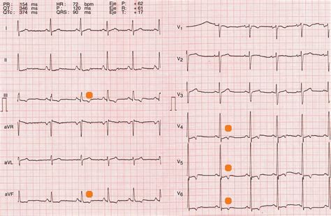 Qu Es La Onda T Anormal En Un Electrocardiograma Haras Dadinco