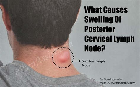 Posterior Cervical Lymph Nodes Cancer