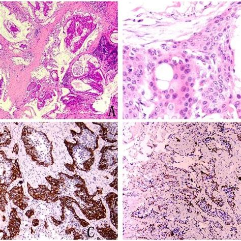 Pathological image of high-grade mucoepidermoid carcinoma (A) Squamous... | Download Scientific ...