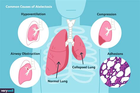 Pneumothorax Vs Atelectasis Lung Arlie Kamila