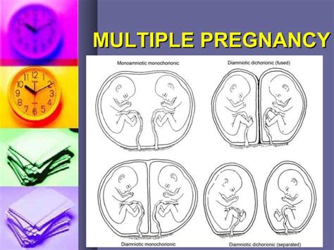 Multiple Pregnancy Ppt