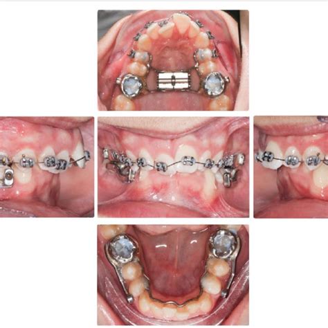 Intraoral Photos Of The Cantilever Herbst Appliance The Herbst