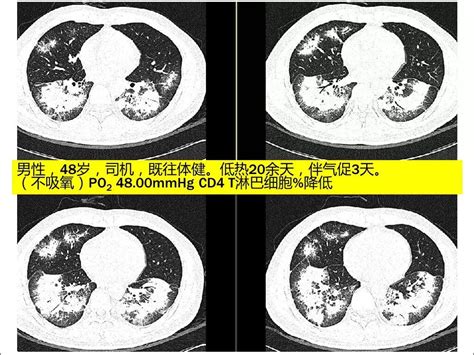 秒懂肺部感染影像看这篇就够了