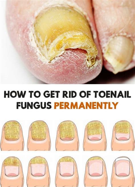 How To Get Rid Of Toenail Fungus Using Just 3 Simple Home Remedies R