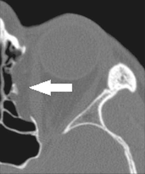 SciELO Brasil Preoperative Computed Tomography Evaluation Of The