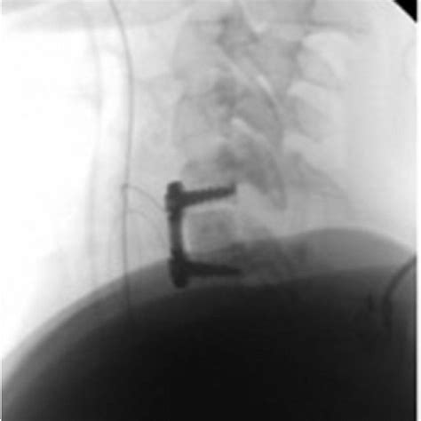 Intraoperative x-ray after C5–6 ACDF demonstrates lucency between the... | Download Scientific ...