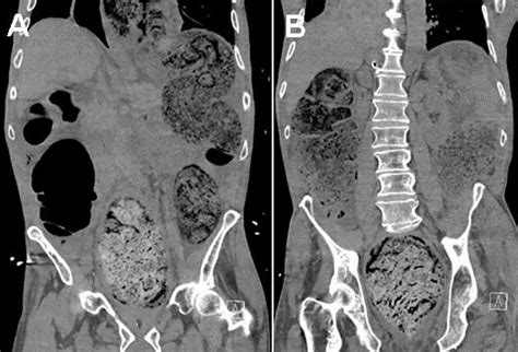 Southwest Journal Of Pulmonary Critical Care And Sleep Imaging Medical Image Of The Month