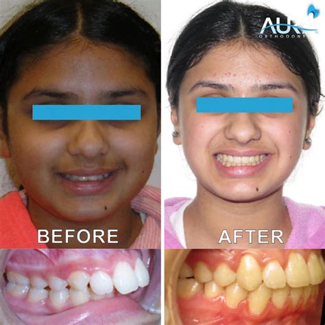 Before And After Braces Overjet