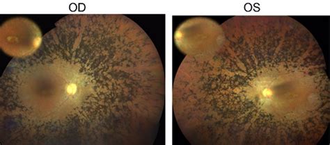 Identifican Un Nuevo Gen Candidato De Retinosis Pigmentaria Con Una