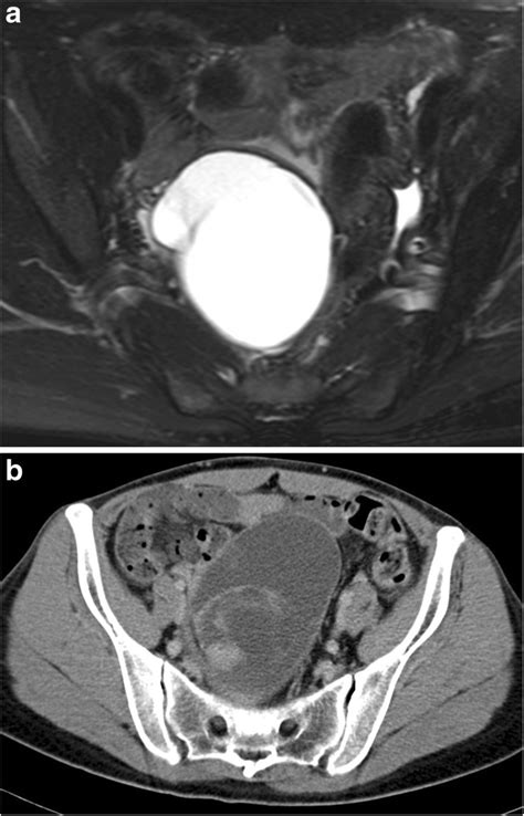 Ovarian Mucinous Cystic Tumor Of Borderline Malignancy With A Mural