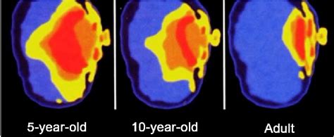 Demonstration Of Mobile Phone Radiation Impact On The Brain For