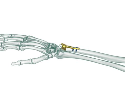 True Lock Distal Ulna Anatomic Plate Truemed Medikal