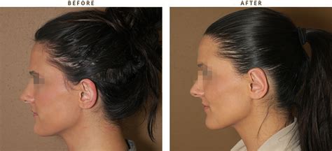 Otoplasty Ear Setback Before After Pictures Dr Turowski