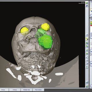 Three Dimensional Computed Tomography Image Brain Lab Medical