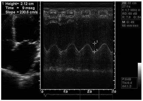 Inter And Intra Observer Variability In The Echocardiographic Evaluation Of Right Ventricular