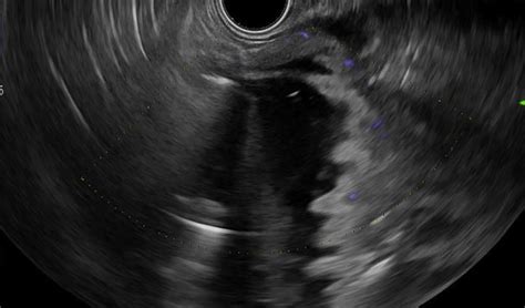 EUS Guided Gastrojejunostomy And Hepaticogastrostomy For Malignant