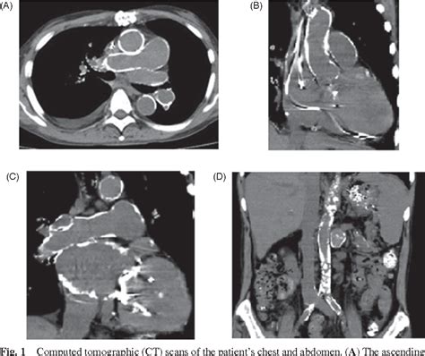 Figure 1 from A stepwise aortic clamp procedure to treat porcelain ...