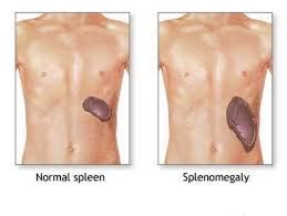 Prepare For Medical Exams Splenomegaly Case Study