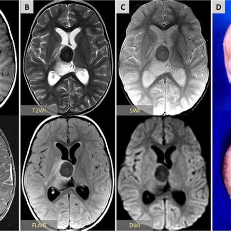 Axial brain MRI through the level of basal ganglia and thalami... | Download Scientific Diagram