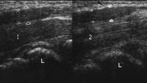 Sonography And MR Imaging Of Bifid Median Nerve With Anatomic And