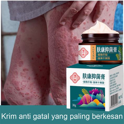 Ubat Gatal Kulit Psoriasis Cream Ubat Gatal Herba Cina Antifungal Cream