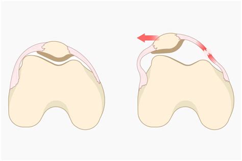 Patella Dislocation Surgery Rockwall TX Manoj Reddy