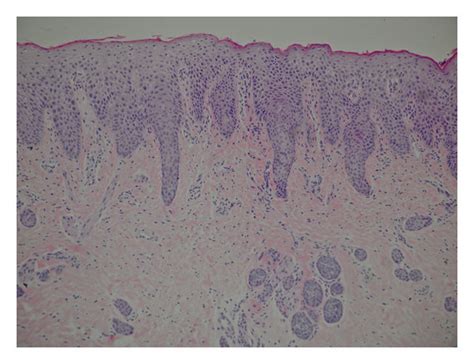 A Skin Biopsy Showing “irregular” Acanthosis Parakeratosis And