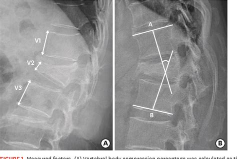 Figure 1 From Can Three Months Of Teriparatide Be One Of Treatment