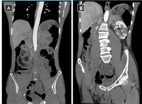 Computed Tomography With Angiography Cta Scan Of The Abdomen And Download Scientific Diagram