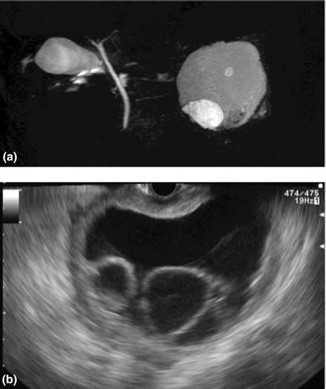 Utility Of Endoscopic Ultrasound And Endoscopic Ultrasoundguided Fine