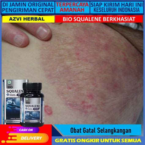 Jual Bio Squalane Softgel Obat Gatal Eksim Kurap Hitam Kadas Gudig