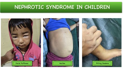 Nephrotic Syndrome in children – Causes | Clinical features ...