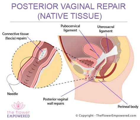 Pelvic Organ Prolapse Pop Affects 50 Of Women Globally