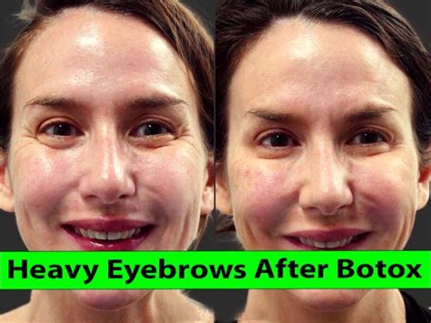 How to Heavy Eyebrows After Botox - Healthy Anozo