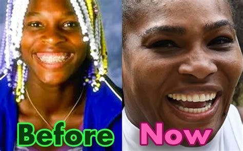 Serena Williams Teeth Before And After: What Happened To Her?