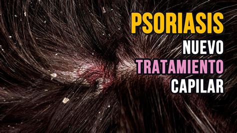 PSORIASIS EN EL CUERO CABELLUDO Mi Nuevo Tratamiento YouTube