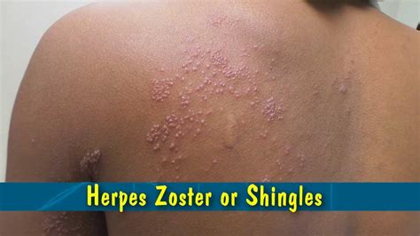 Herpes Zoster Or Shingles Youtube