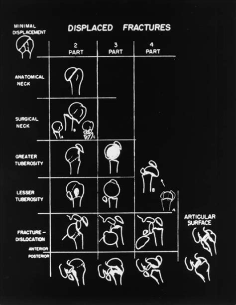 Fractures Of The Proximal Humerus Orthopedic Clinics