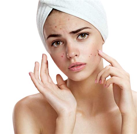 Acne Scar Treatment Antalya Dermatologist Dr Melda Özekinci